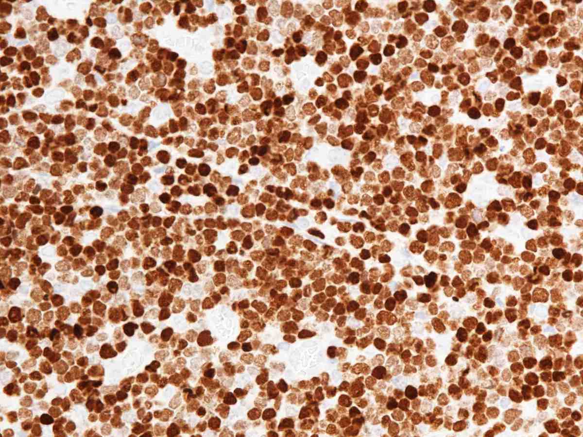 Lymph node 2010 TDT 40X